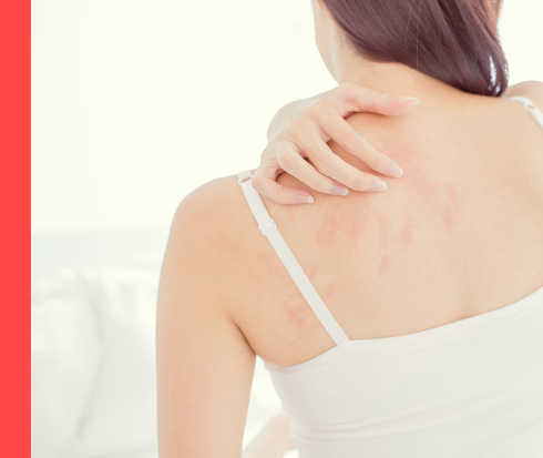 Psoriasis: Ursachen Eine dunkelhaarige Frau ist von hinten zu sehen. Sie betastet rötliche Flecken auf ihrem Schulterblatt.