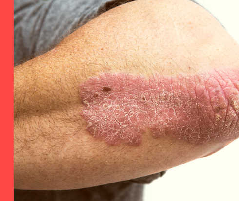 Psoriasis: Diagnose Bildausschnitt eines Ellenbogens, auf dem ein rötlicher, schuppiger Hautausschlag zu sehen ist.