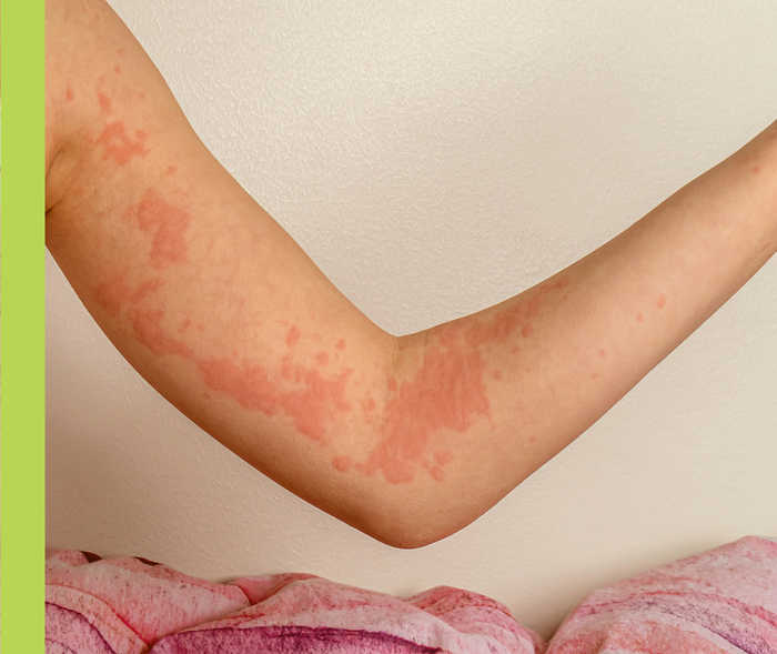 Nesselsucht Kinder Der Arm eines Kindes mit Urtikaria-typischem Ausschlag.