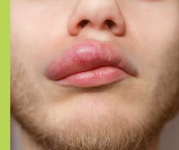 Nesselsucht: Angioödem an Lippe Bildausschnitt einer Nase und eines Munds mit geschwollener Oberlippe.