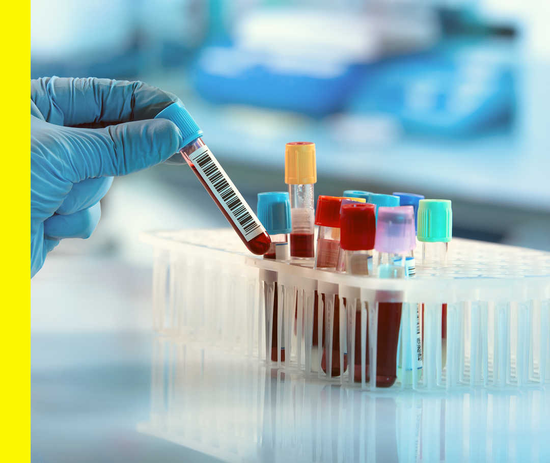 Akne inversa: Diagnose Auf dem Bild sind diverse Reagenzgläser zu sehen