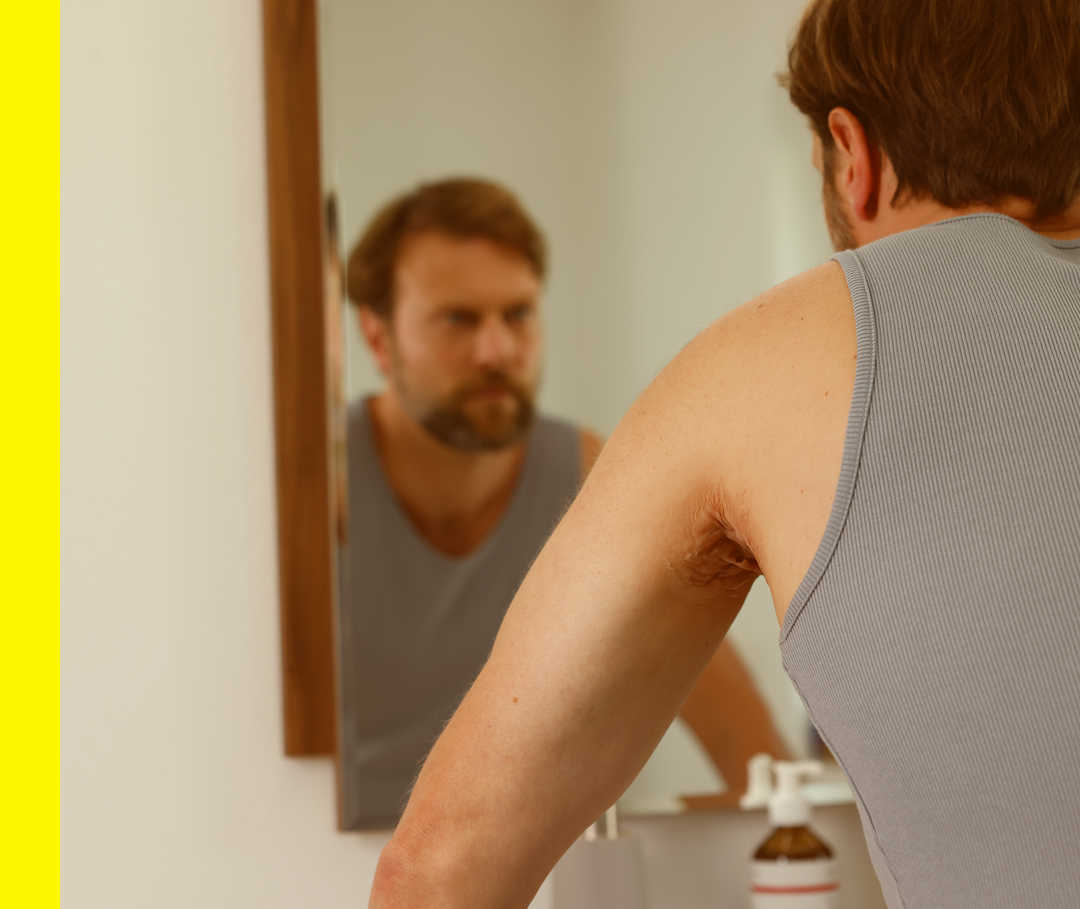 Akne inversa: Ratgeber Ein Mann steht vor dem Spiegel und hat ein Tanktop an.