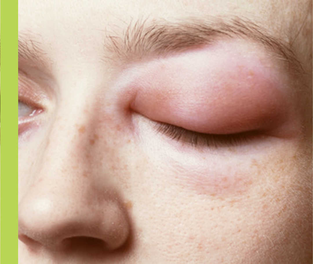 Nesselsucht-Symptome: Angioödem am Auge Bildausschnitt eines stark angeschwollenen Augenlids.