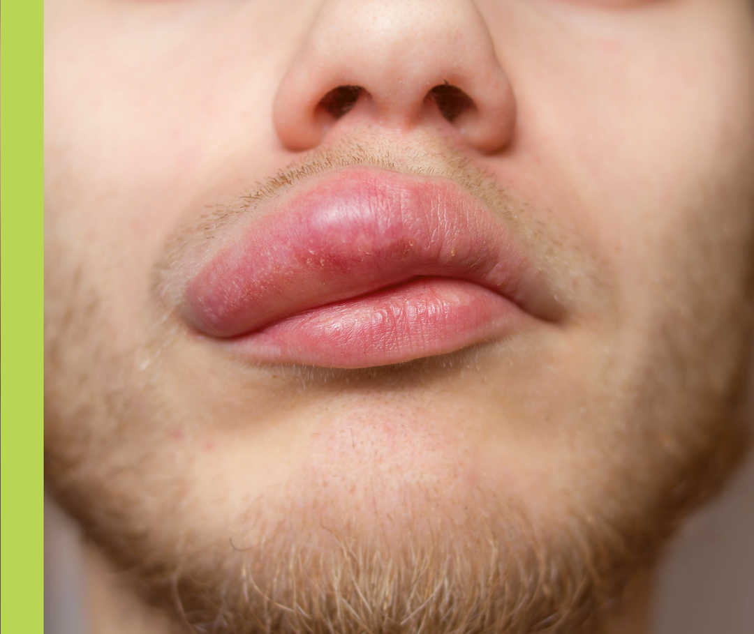 Nesselsucht: Angioödem an Lippe Bildausschnitt einer Nase und eines Munds mit geschwollener Oberlippe.