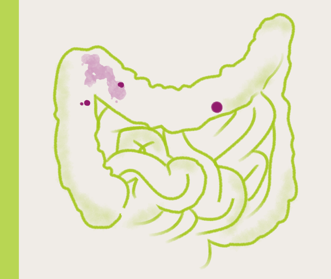 Nesselsucht-Symptome: Illustration Darmsymptome Illustration des Darms. Rote Markierungen zeigen symbolisch Krankheitssymptome.