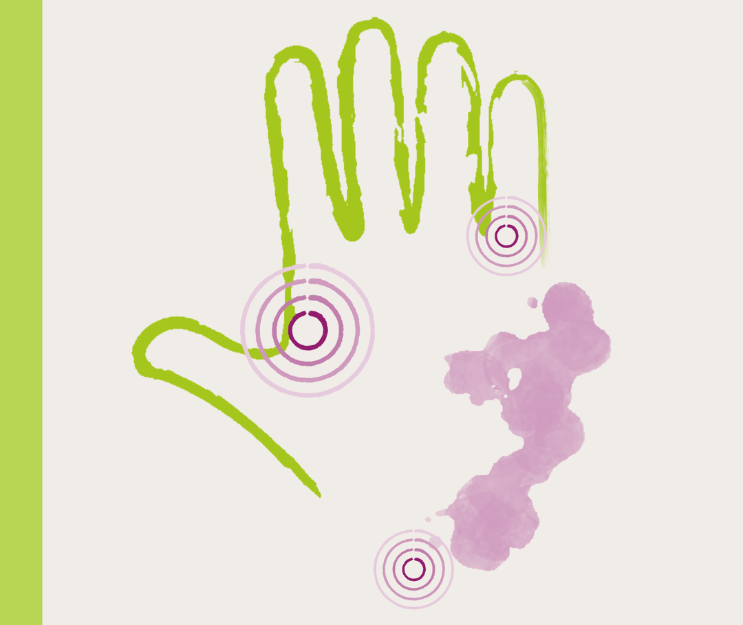 Nesselsucht-Behandlung: Illustration Hand Illustration einer Hand mit der symbolischen Darstellung von Hautausschlag.