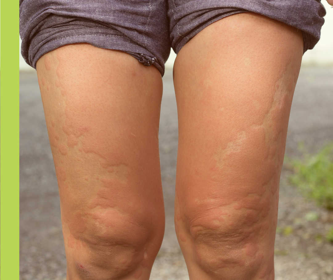 Nesselsucht-Symptome: Quaddeln Oberschenkel Knie und Oberschenkel einer Person mit großflächigen rötlichen Schwellungen.