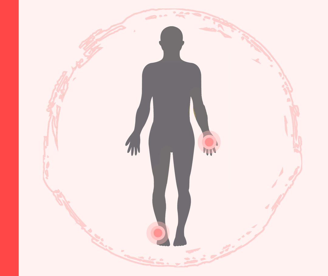 Schuppenflechte an Handflächen und Fußsohlen Grafik einer Person mit roter Markierung am rechten Fuß und an der linken Hand, die die Schuppenflechte darstellen soll.