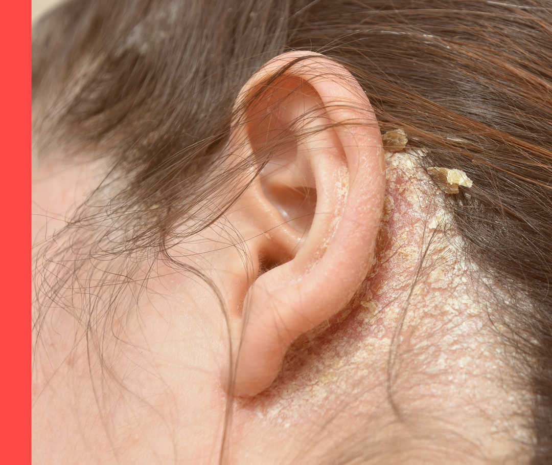 Kopfhaut – Psoriasis hinter dem Ohr Person mit Schuppen hinter dem Ohr.