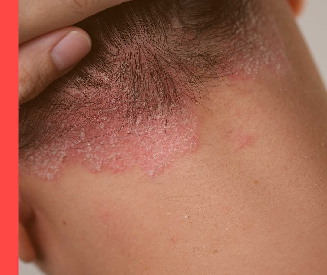 HAUTWENDE: Psoriasis – Schuppen oder Schuppenflechte? Hautschuppen am Haaransatz oberhalb des Halses.