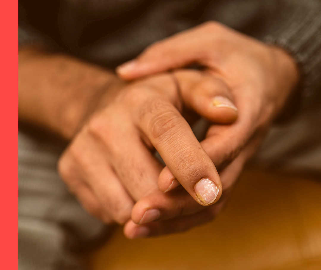 Nagelpsoriasis am Zeigefinger Die Hände einer Person. Der rechte Zeigefinger ist von Nagelpsoriasis betroffen.