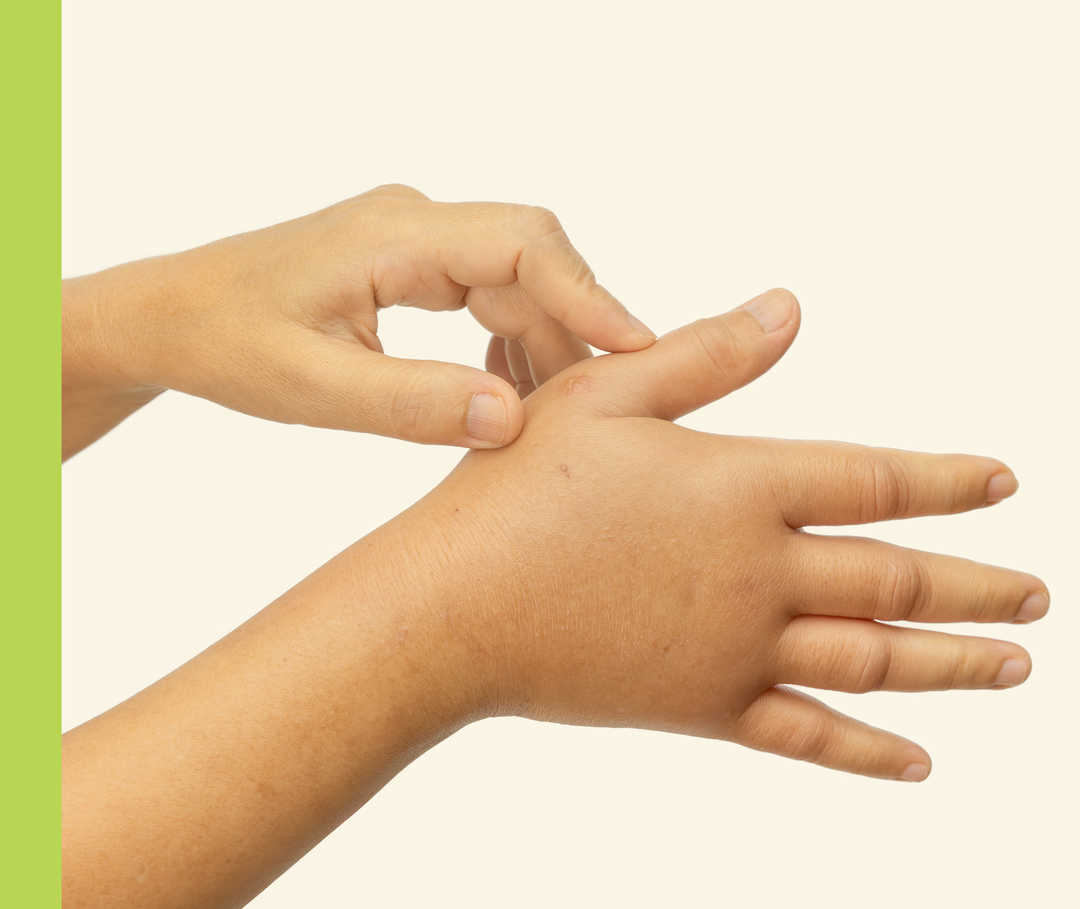 Urtikaria: Melittas Symptome Nahaufnahme einer angeschwollenen Hand.