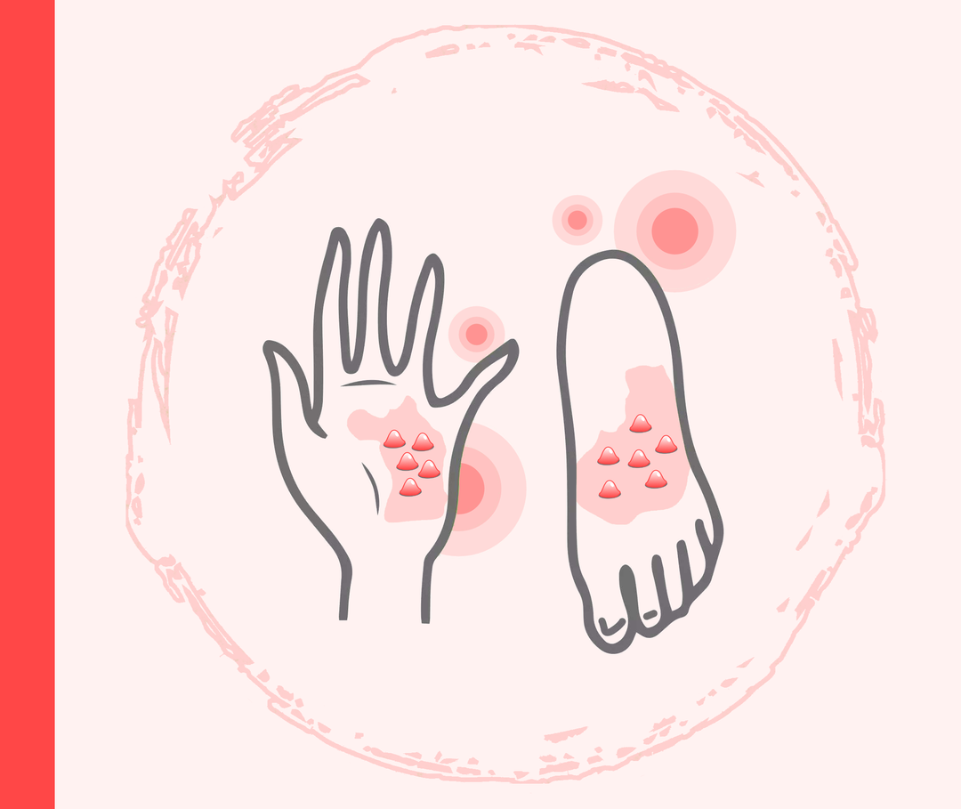 Psoriasis pustulosa: Eitrige Bläschen auf der Haut Grafik einer Handfläche und einer Fußsohle, auf denen jeweils Bläschen zu sehen sind.