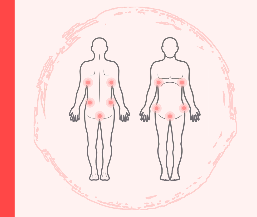 Psoriasis inversa an den Hautfalten Grafik eines menschlichen Körpers von hinten und von vorn mit roten Markierungen der Leisten- und Achselbereiche, die die Psoriasis inversa darstellen sollen.