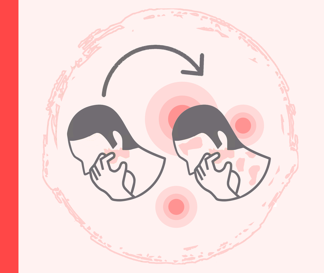 Kratzen verstärkt Psoriasis-Symptome Die Grafik zeigt zweimal den Kopfbereich einer Person, die sich im Gesicht kratzt. Bei der linken Abbildung ist nur ein Bereich im Gesicht rot markiert, bei der rechten sind es mehrere Stellen.