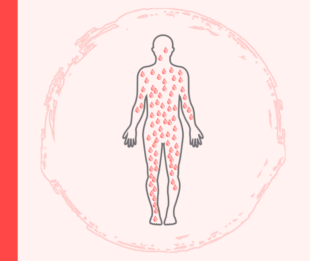 Psoriasis guttata: Tropfenförmige Flecken auf der Haut Umriss eines Menschen mit roten Tropfen, die die Psoriasis guttata symbolisieren.