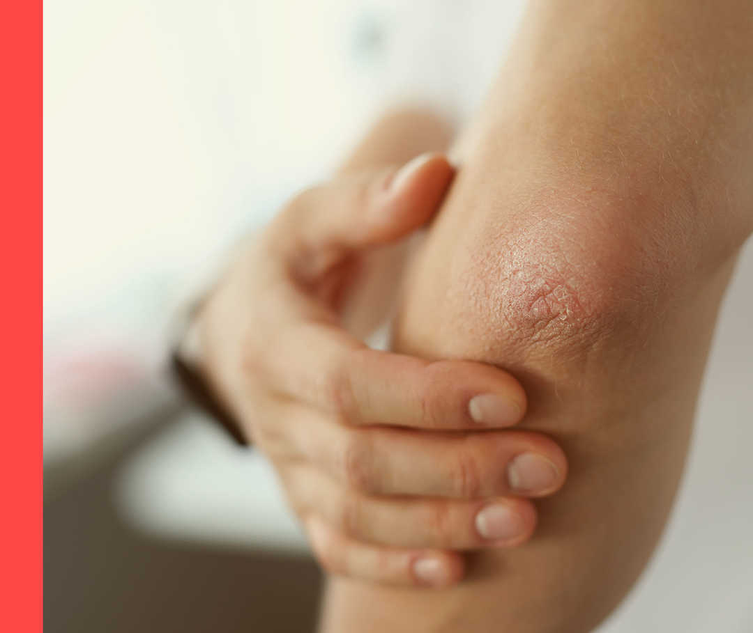 Eine Person fährt mit der rechten Hand über den linken Ellenbogen, auf dem schuppige Hautsymptome zu sehen sind. HAUTWENDE: Psoriasis-FAQ