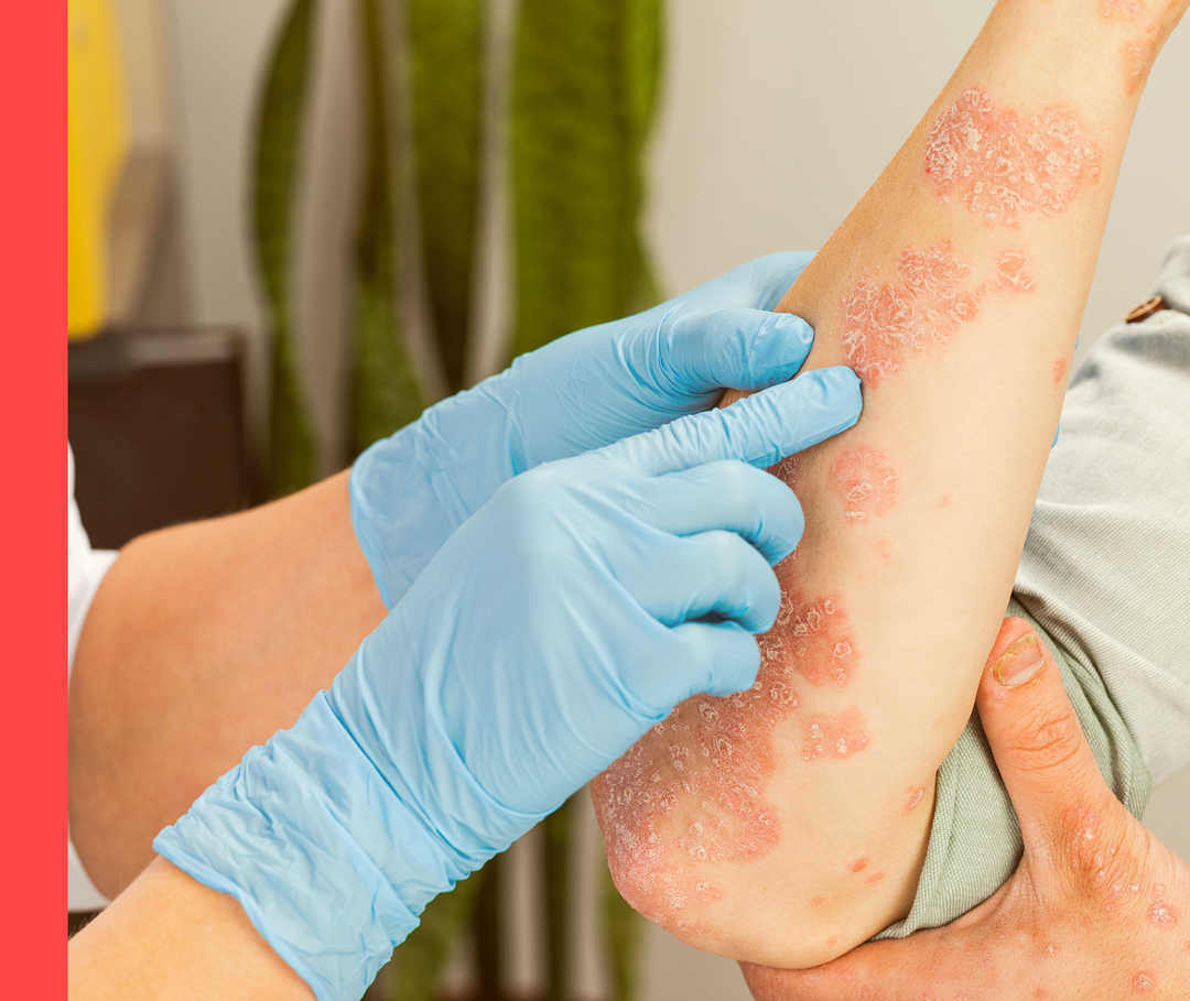 Psoriasis: Arztgespräch Der Arm eines Patienten mit Schuppenflechte.