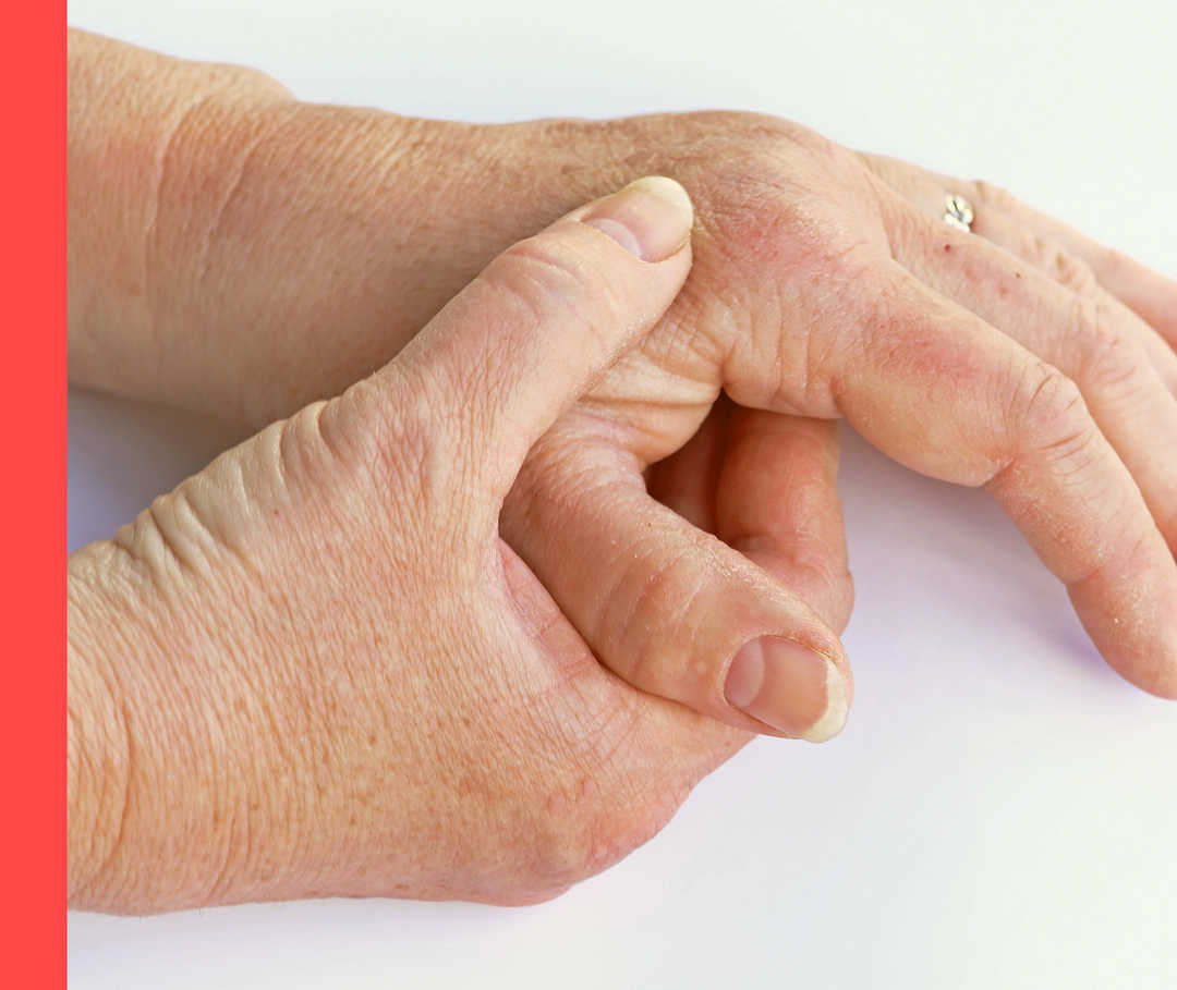Psoriasis-Arthritis Hände einer älteren Person. Eine Hand umgreift die andere.