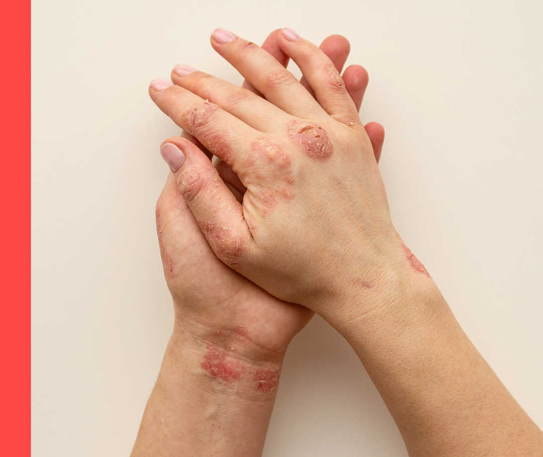 Hautwende erleben: Hilfe bei Psoriasis-Schub Zwei Hände liegen auf einem Tisch. Die Haut ist an mehreren Stellen gerötet und schuppig.