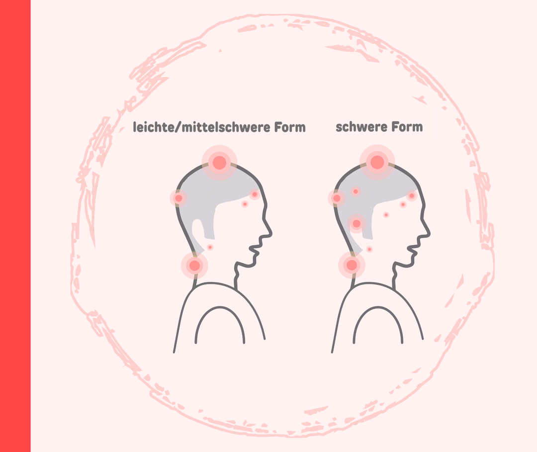 Kopfhaut-Psoriasis: Schweregrade Umrisse zweier Personen in der Seitansicht mit unterschiedlich vielen roten Markierungen im Kopfbereich. Über einer Person steht „leichte/mittelschwere Form“, über der anderen „schwere Form“.