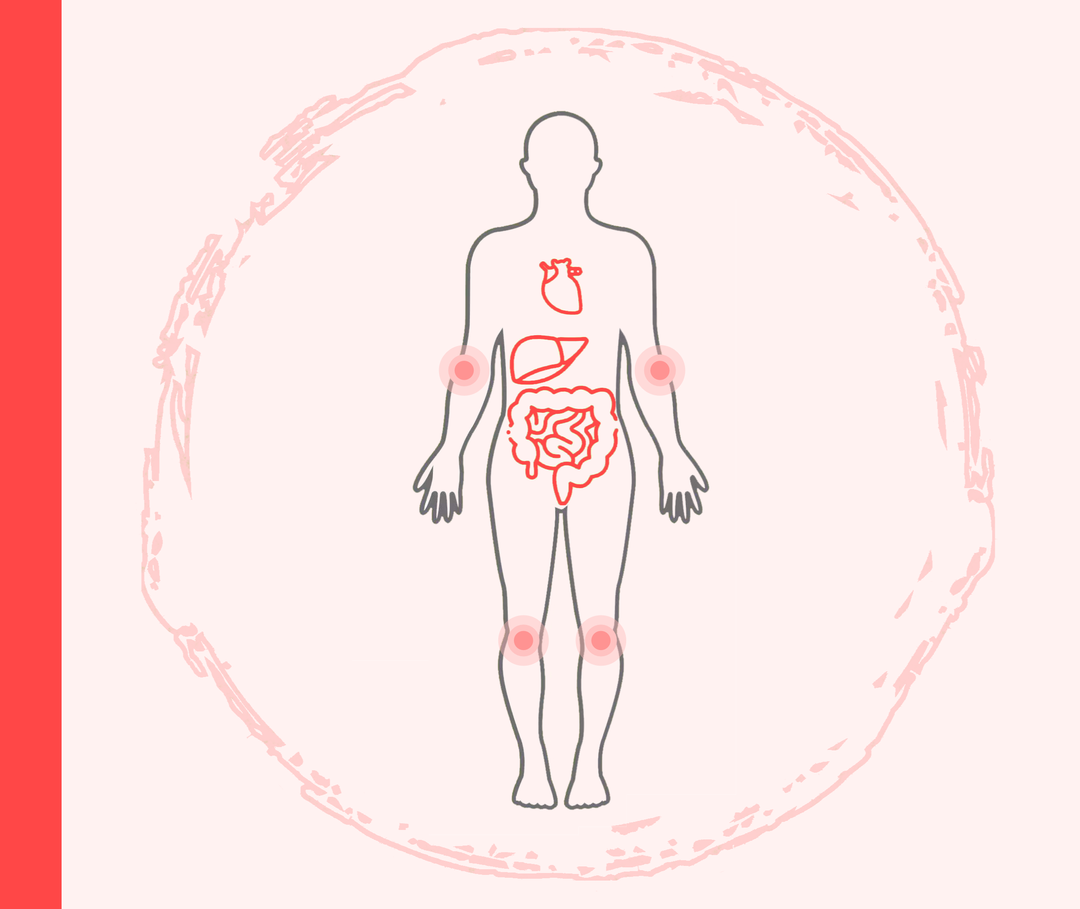 Psoriasis: Begleiterkrankungen Umriss einer Person mit roten Markierungen im Bereich der Ellenbogen- und Kniegelenke sowie Darstellung des Herzens, der Leber und des Darms.