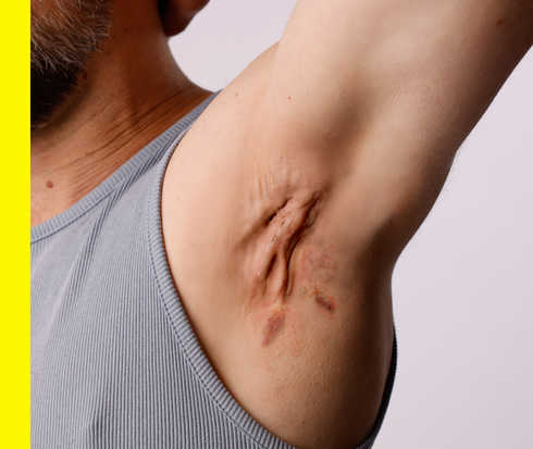 In der Achselhöhle eines Manns, dessen Gesicht nicht zu sehen ist, sind Hautsymptome zu erkennen.