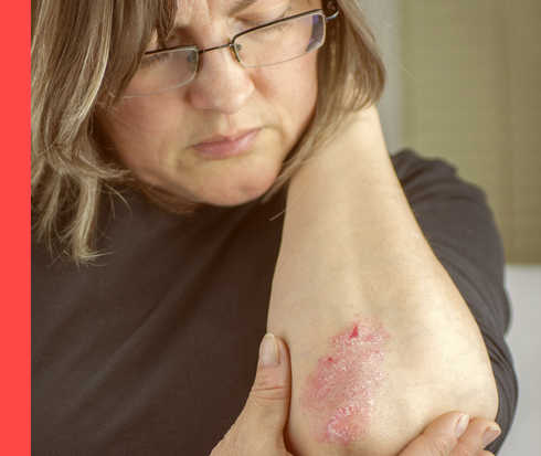 Eine Frau mit Brille hält ihre linken Ellenbogen hoch und betrachtet dort rötliche, schuppige Hautsymptome.