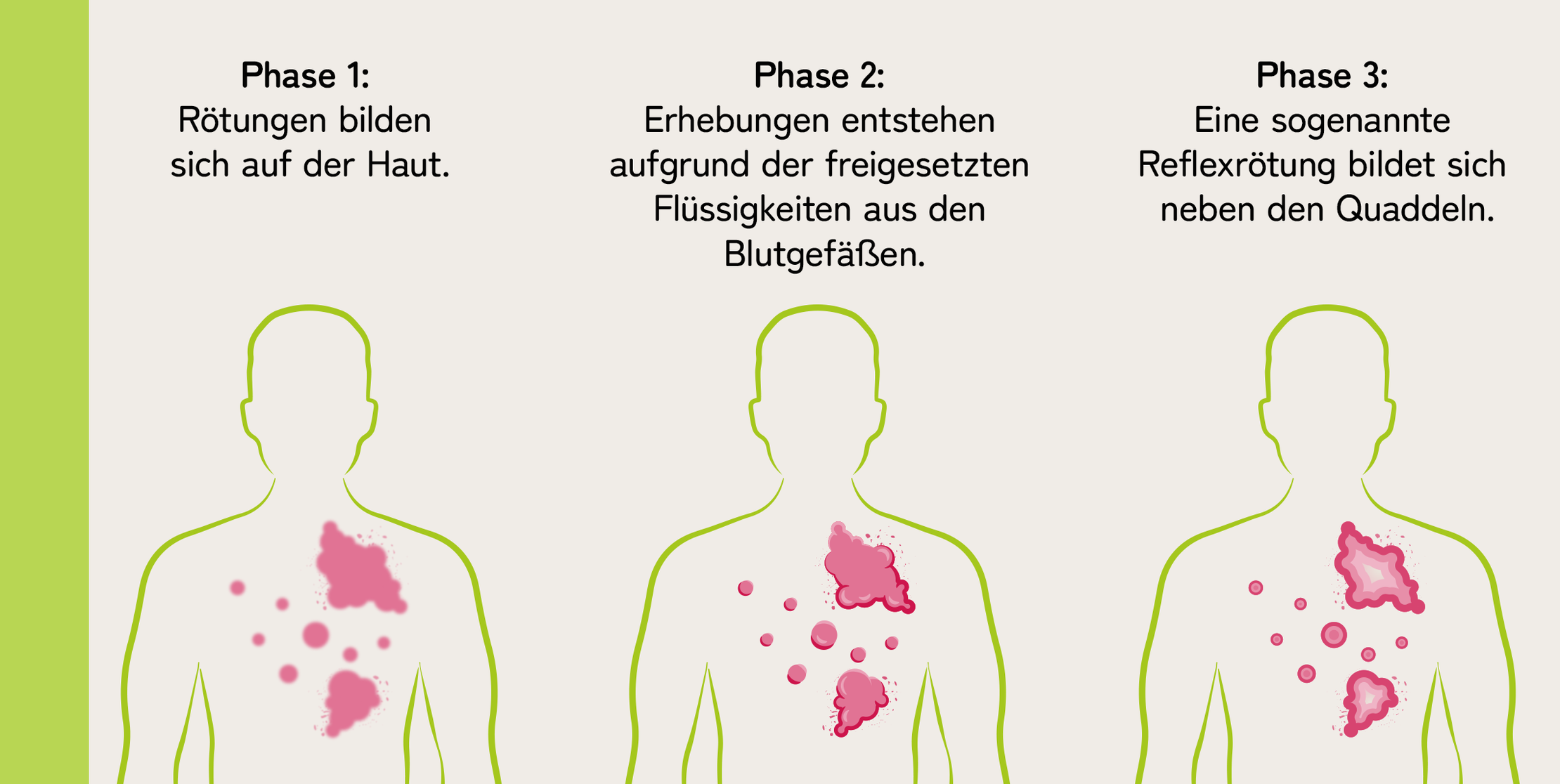 Nesselsucht Symptome Eine Grafik zeigt die drei unterschiedlichen Phasen der Quaddelbildung bei Nesselsucht.