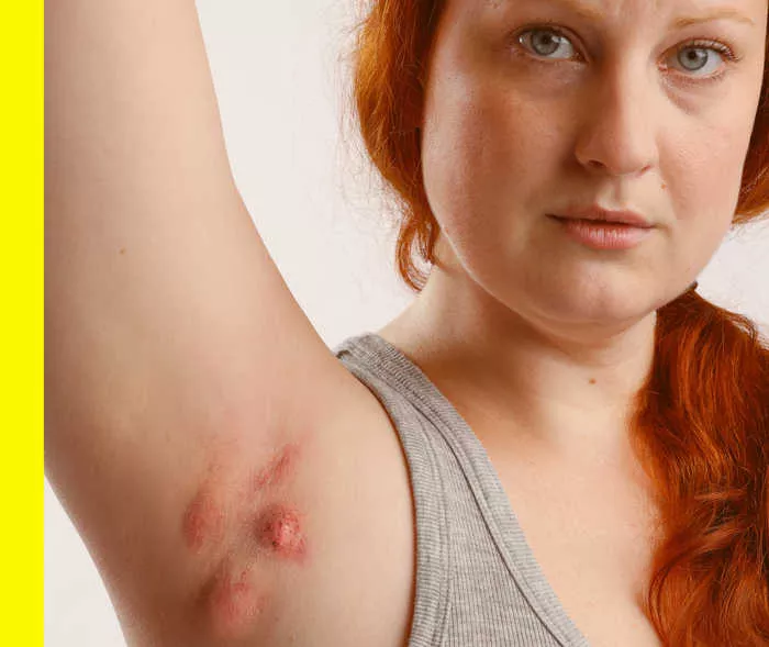 Eine Frau hebt ihren Arm, an der Achsel sieht man Hautknoten.