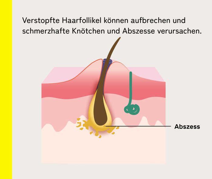 Schematische Darstellung der Abszessbildung bei Akne inversa mit dem Erklärtext: „Verstopfte Haarfollikel können aufbrechen und schmerzhafte Knötchen und Abszesse verursachen.“