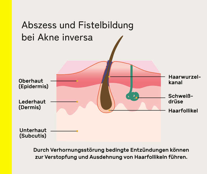 Schematische Darstellung der Haut mit dem Erklärtext: „Durch Verhornungsstörung bedingte Entzündungen können zur Verstopfung und Ausdehnung von Haarfollikeln führen.“