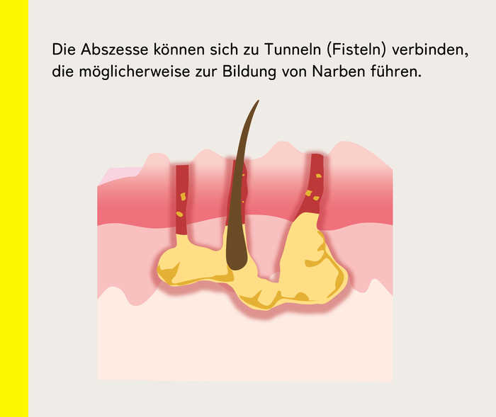 Schematische Darstellung der Fistelbildung bei Akne inversa mit dem Erklärtext: „Die Abszesse können sich zu Tunneln (Fisteln) verbinden, die möglicherweise zur Bildung von Narben führen.“