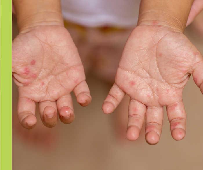 Ein Kind zeigt seine Hände mit Ausschlag.