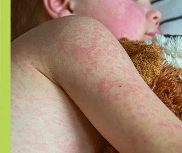 Ein Kind mit Masern-Ausschlag hält ein Kuscheltier.