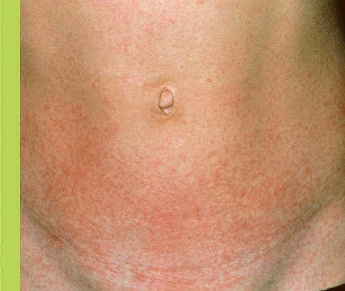 Typischer Scharlach-Ausschlag am Bauch eines Kindes.