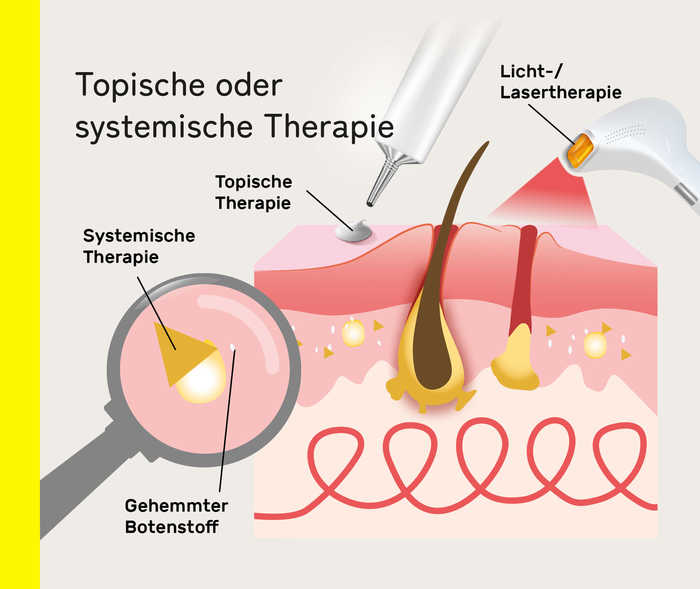 Infografik mit Darstellung der Schichten von behandelter Haut mit Akne inversa.