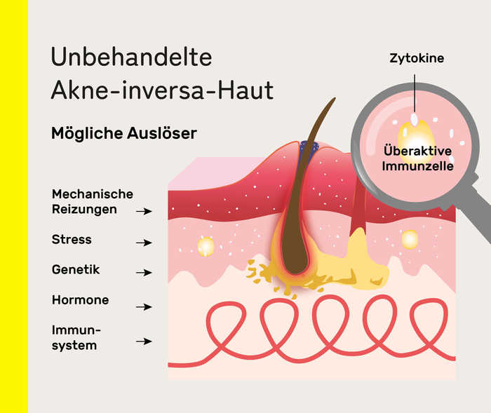 ] Infografik mit Darstellung der Schichten von unbehandelter Haut mit Akne inversa.