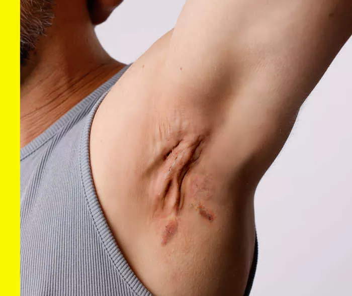 Ein Mann hebt seinen Arm, an der Achsel sieht man Akne inversa im dritten Stadium