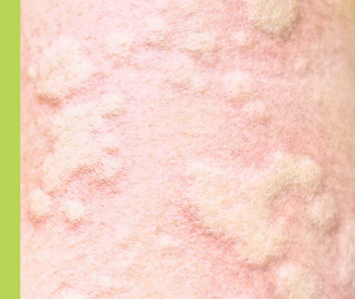 Hautbereich mit unterschiedlich großen Quaddeln.