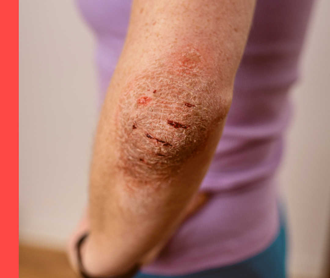 Nahaufnahme eines unbekleideten Ellenbogens mit geröteter, schuppiger Haut.