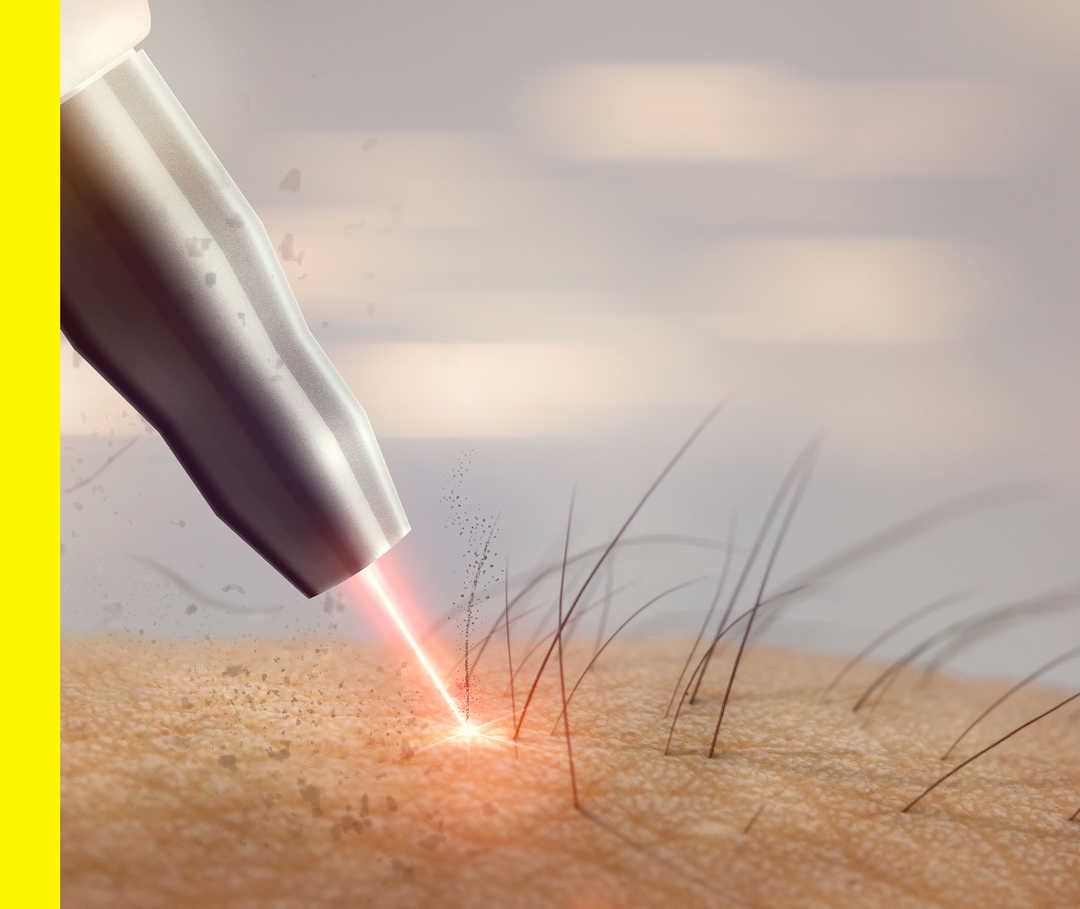 Laserstrahl, der auf Haut trifft. 