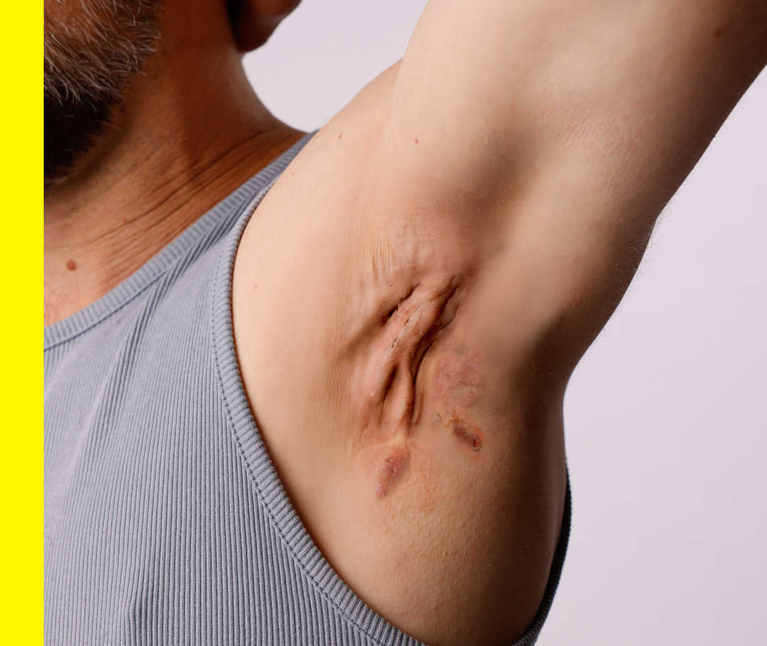 In der Achselhöhle eines Manns, dessen Gesicht nicht zu sehen ist, sind Hautsymptome zu erkennen.