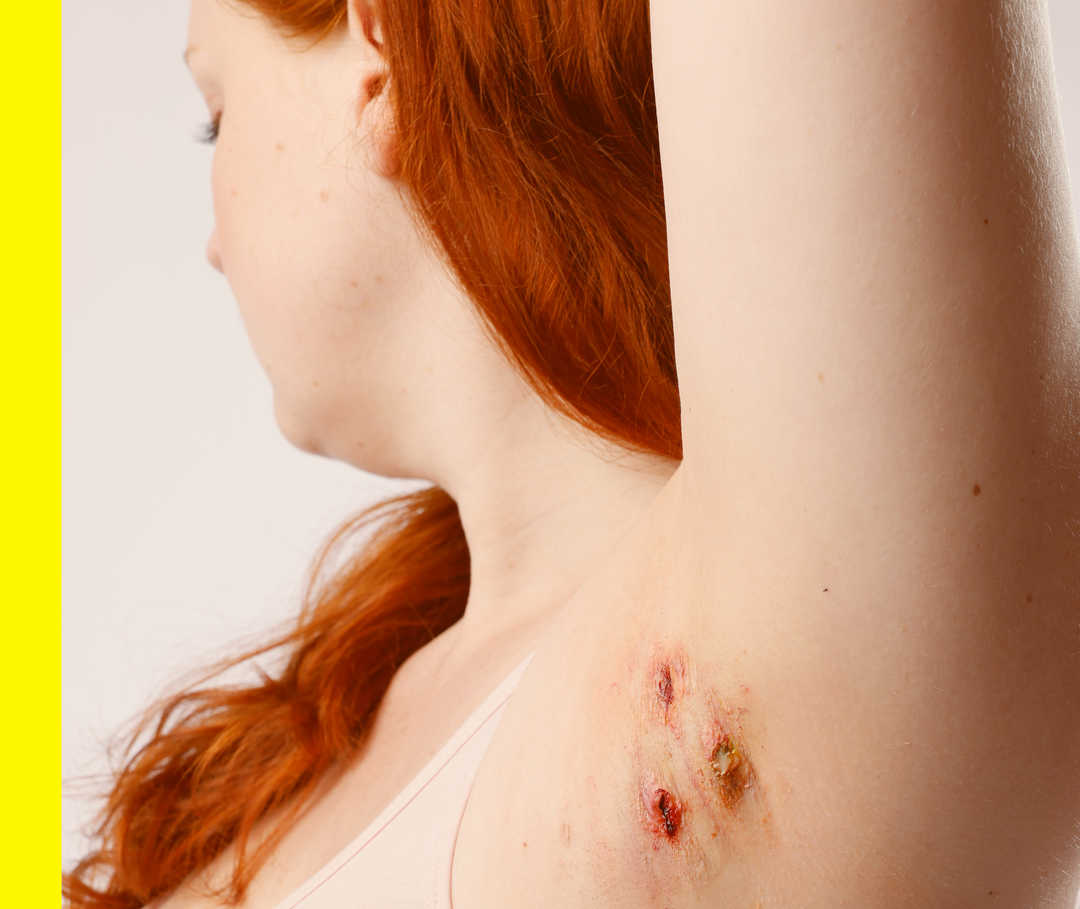 Eine Frau hebt ihren Arm, an der Achsel sieht man Akne inversa.