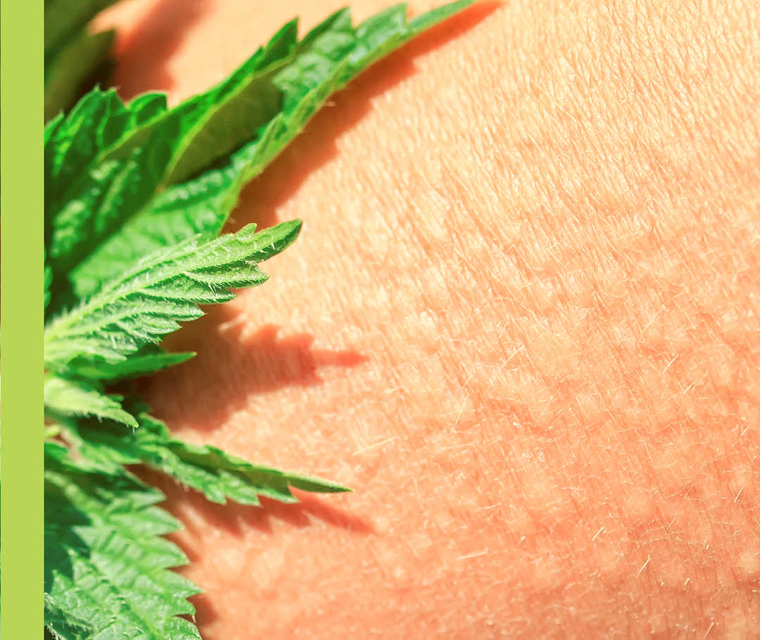 Grüne, zackige Brennnesselblätter auf einem Hautbereich mit kleinen weißlichen Schwellungen.