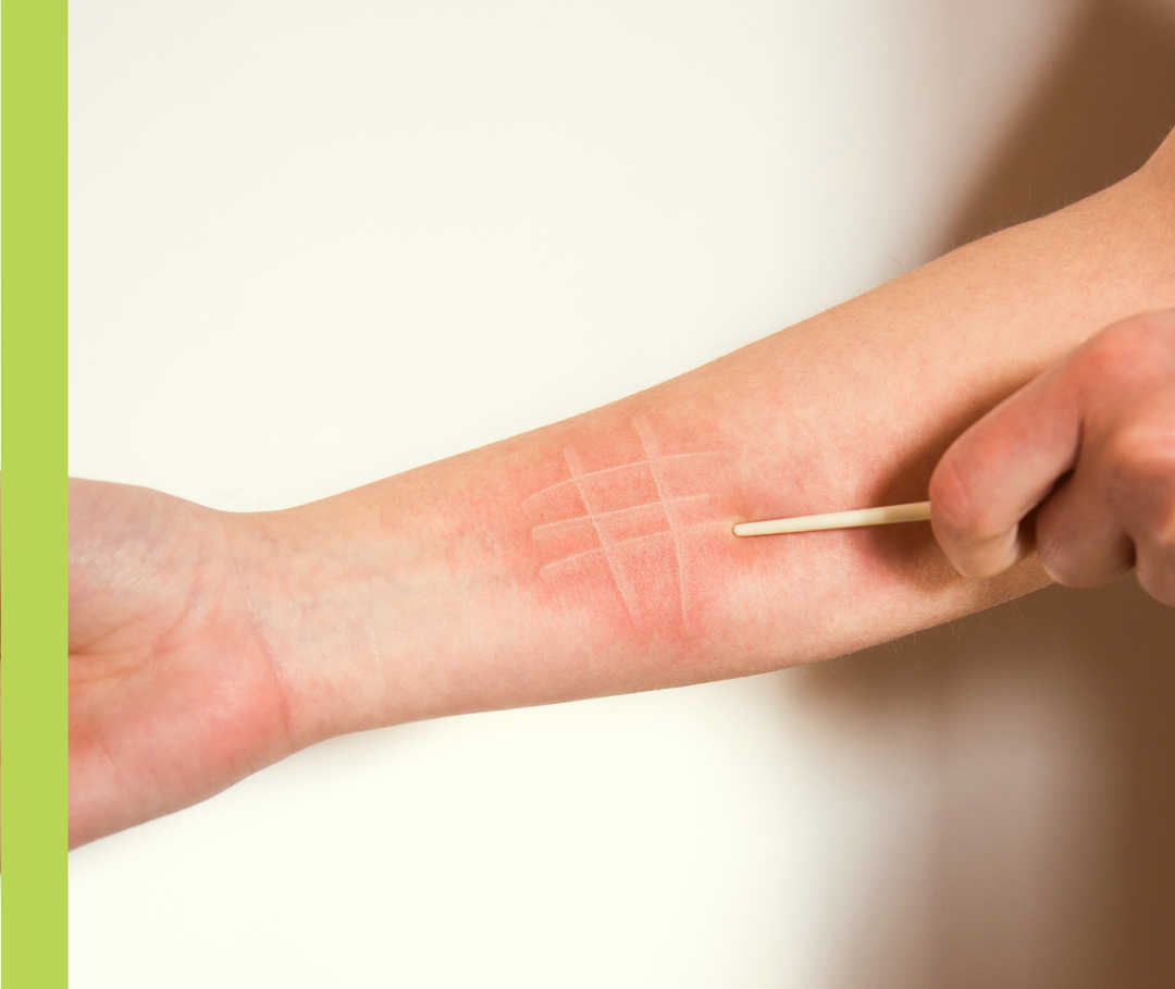 Unterarm einer Person mit gerötetem Bereich, in dem helle Striche zu sehen sind.