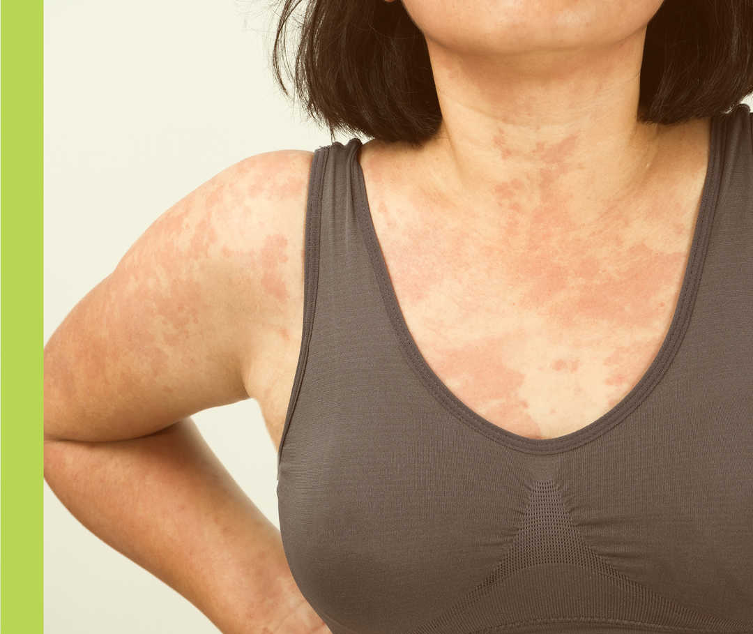 Schulter, Oberarm und Dekolleté einer Frau mit rötlichem Hautausschlag.