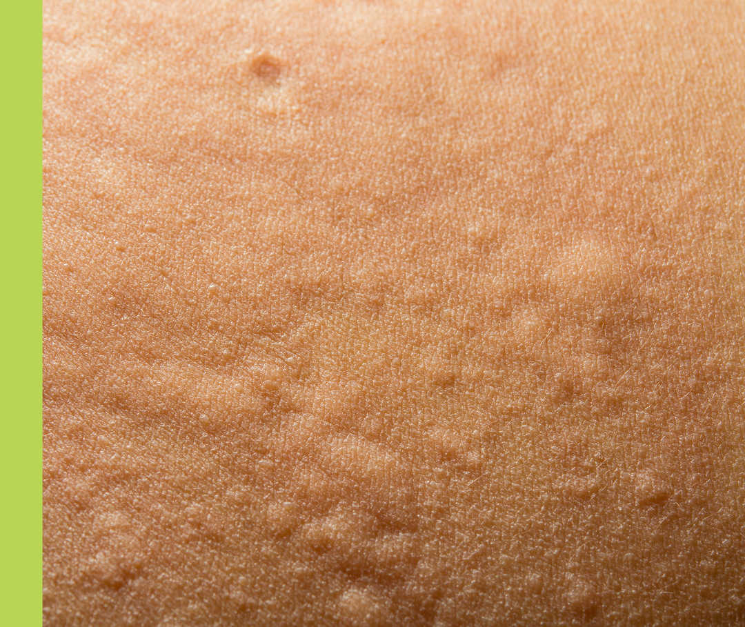 Auf einer Haut haben sich Quaddeln gebildet