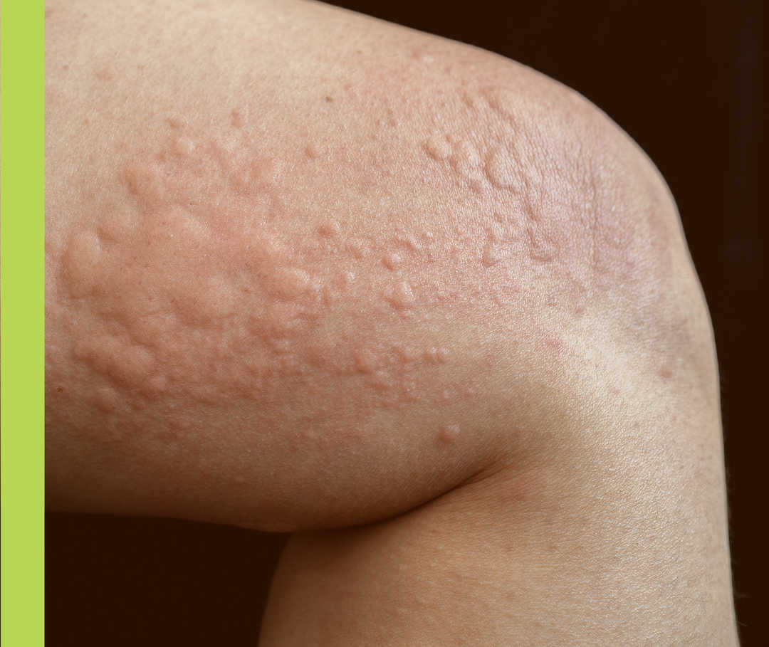 Ein angewinkeltes Bein mit vielen weißlichen Schwellungen auf der Haut.