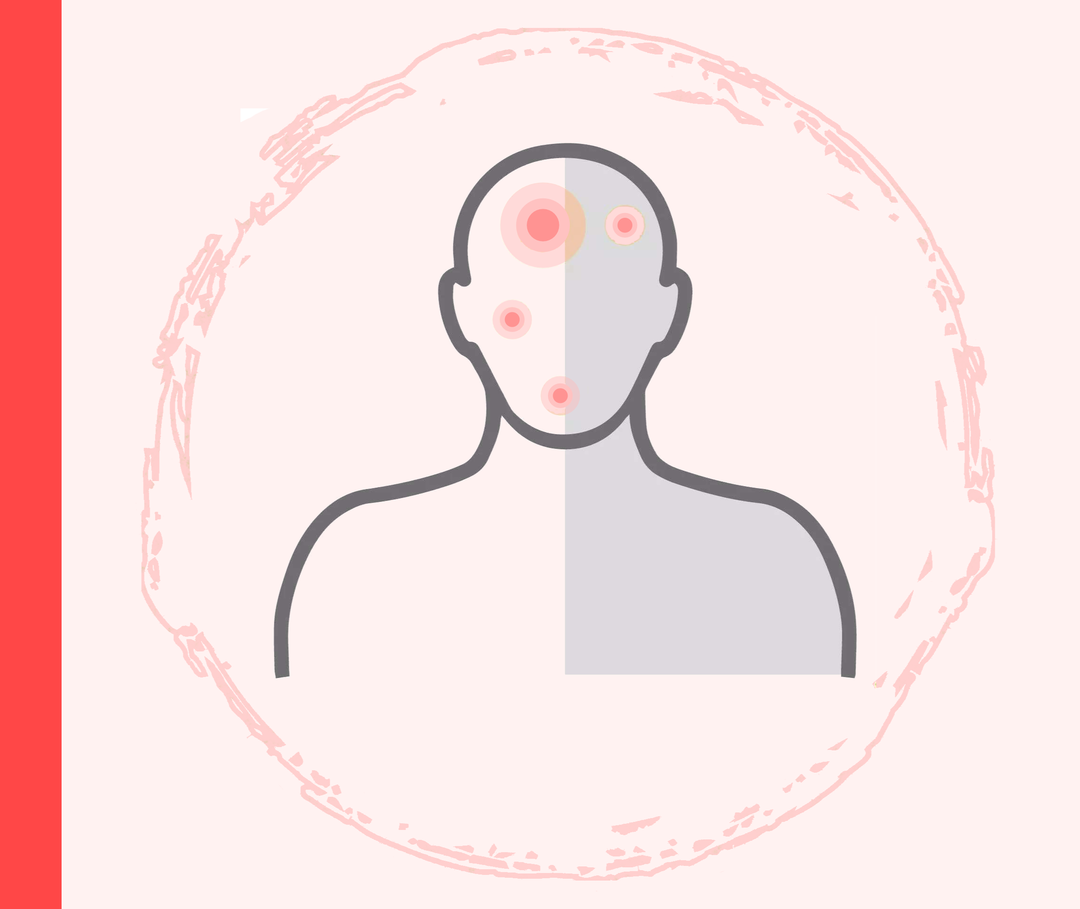 Grafik eines Kopfes und Oberkörpers mit roten Markierungen im Bereich des Gesichts, die die Schuppenflechte darstellen sollen.